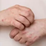 Valley fever